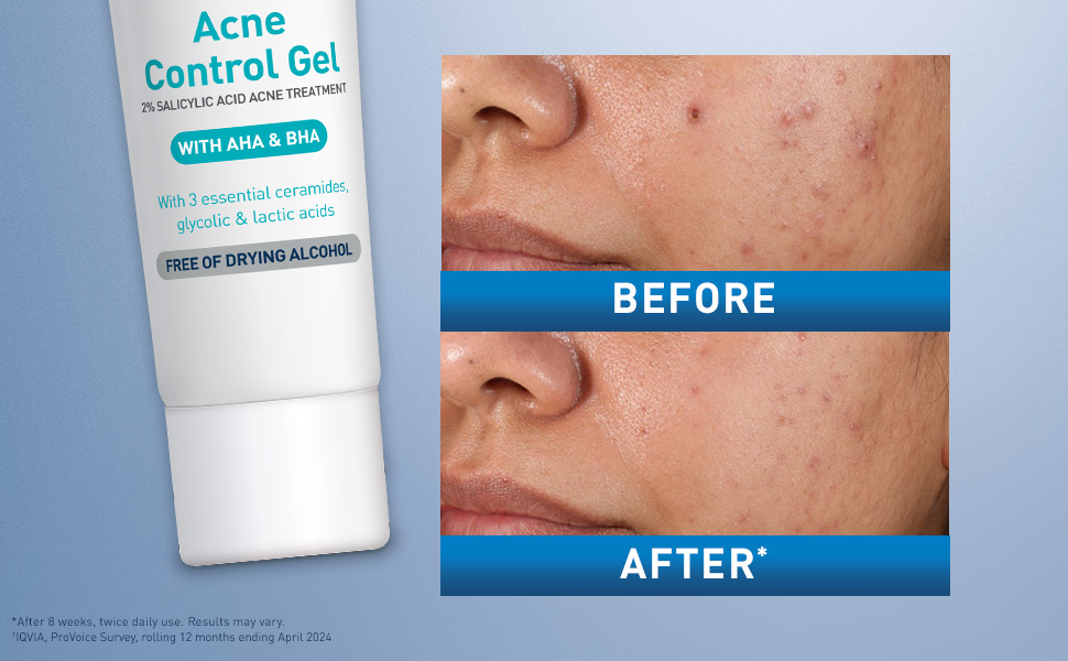 Acne Control Gel